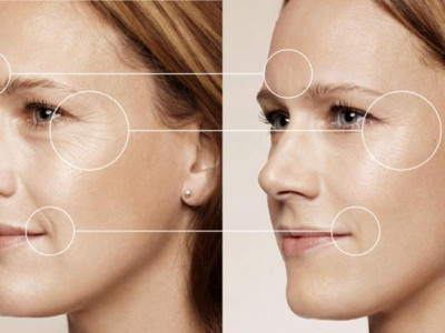 Tratamente cu acid hialuronic