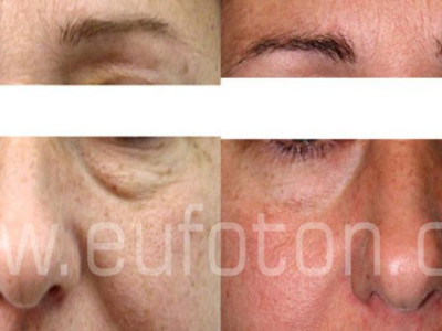 Blefaroplastie laser pleoapa inferioara cu laserul Eufoton / Aton